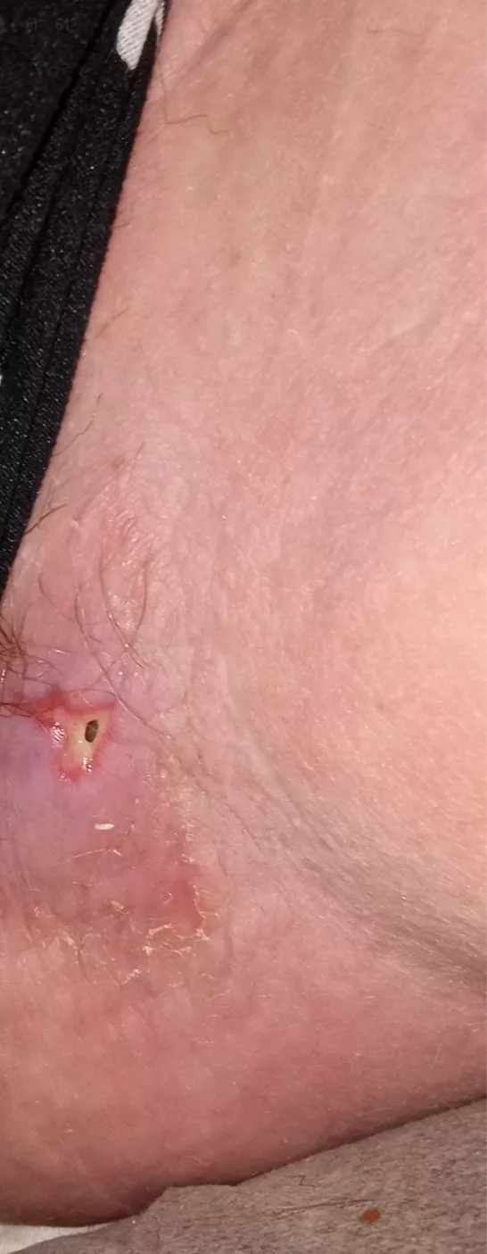 Abcess Update!! Surgery left a hole for drainage..Pain is pretty minimal. 10/10 worst experience ever