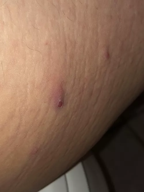 inner thigh; won’t pop and super painful :(