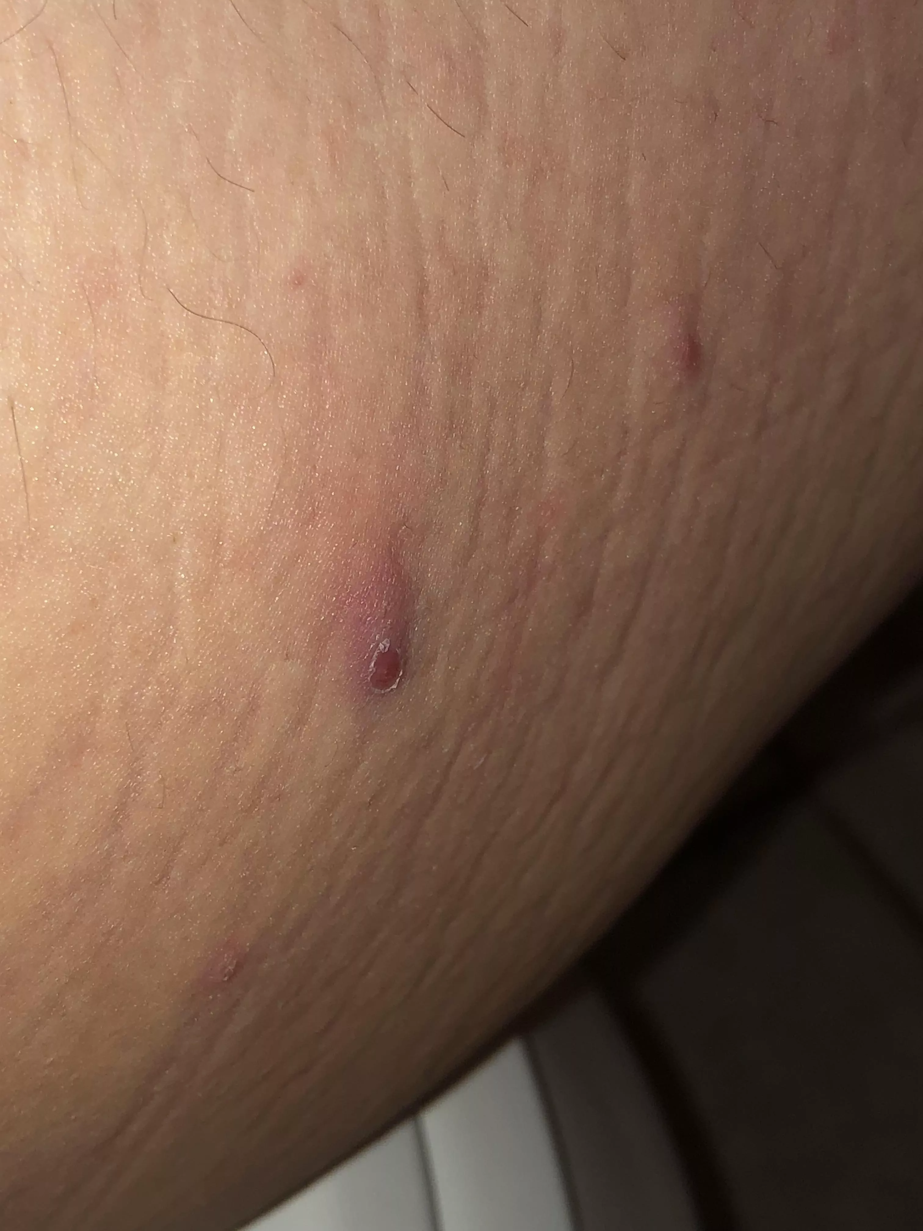 inner thigh; won’t pop and super painful :(