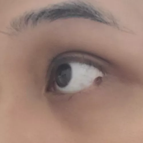 Does anyone know what this brown bump on my lower eyelid is called?