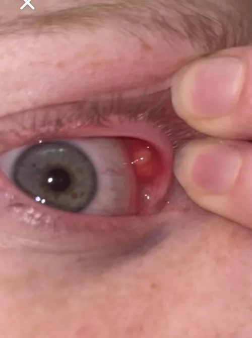 Internal stye after 4 days of antibiotics