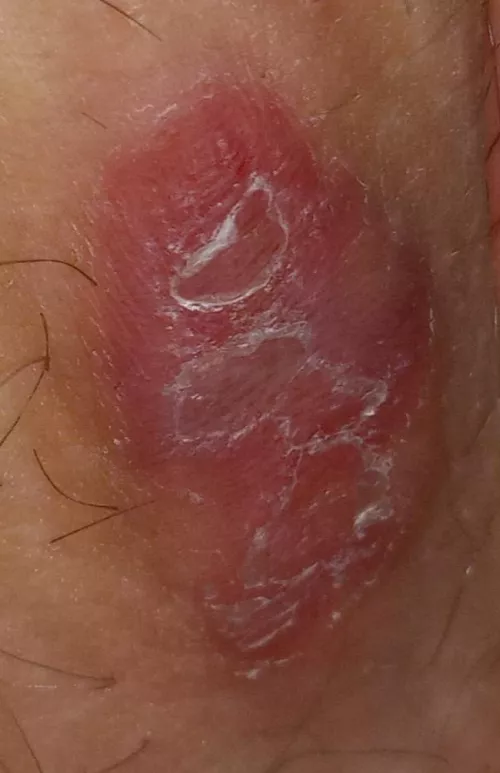 This fucker is on my inner thigh. Its been there on and off for months, but never this bad. Is it a boil? It looks awful and hurts bad.