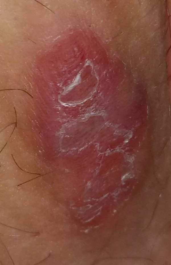 This fucker is on my inner thigh. Its been there on and off for months, but never this bad. Is it a boil? It looks awful and hurts bad.