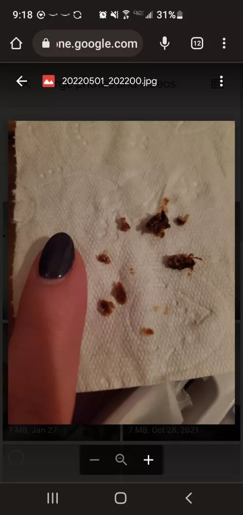 So early this year my left ear went on off slightly muffled. I finally got an ear cleaning camera in May and this was almost completely blocking my ear drum! The pressure release was immense. It was so dark in color, who knows how long I'd been living w