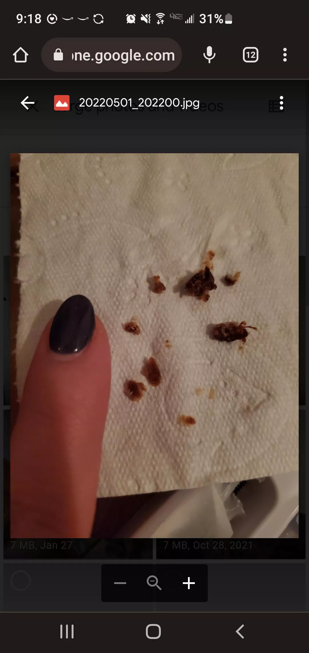 So early this year my left ear went on off slightly muffled. I finally got an ear cleaning camera in May and this was almost completely blocking my ear drum! The pressure release was immense. It was so dark in color, who knows how long I'd been living w