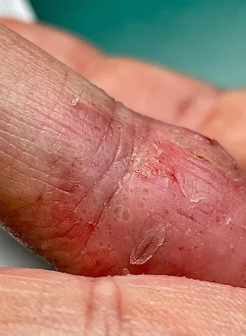 This is atopic eczema on my finger. There are dozens of these little blisters. You have no idea how itchy they are.