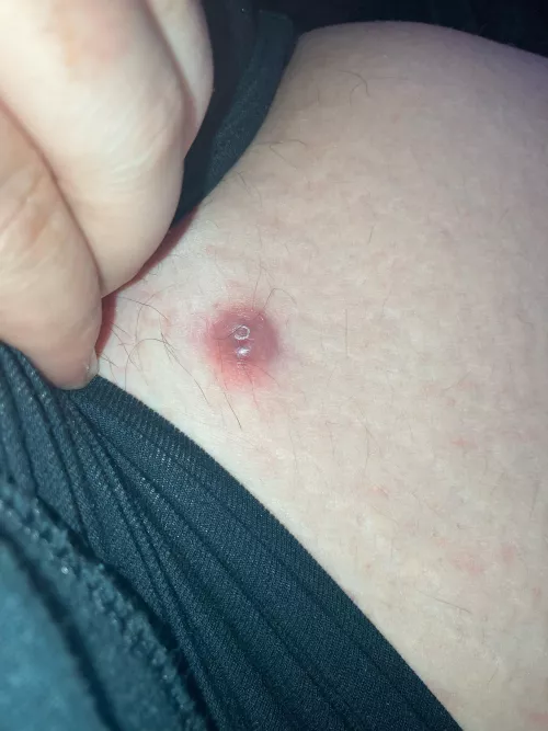 Anyone know what this is? Hurts like fuck kinda itchy and near my pubic area