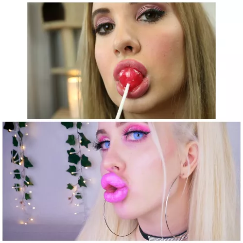 Before and after fillers