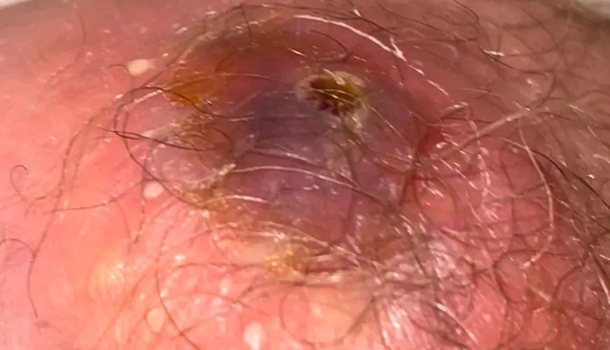 Uncertain of what this cyst is but it’s getting worse everyday, located near inner part of butt