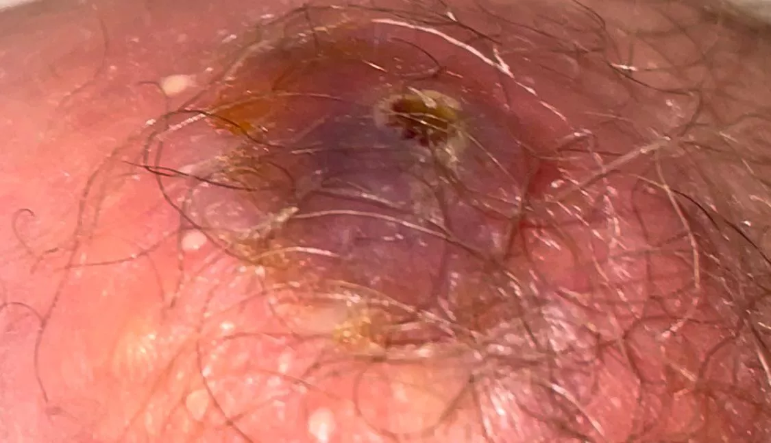 Uncertain of what this cyst is but it’s getting worse everyday, located near inner part of butt