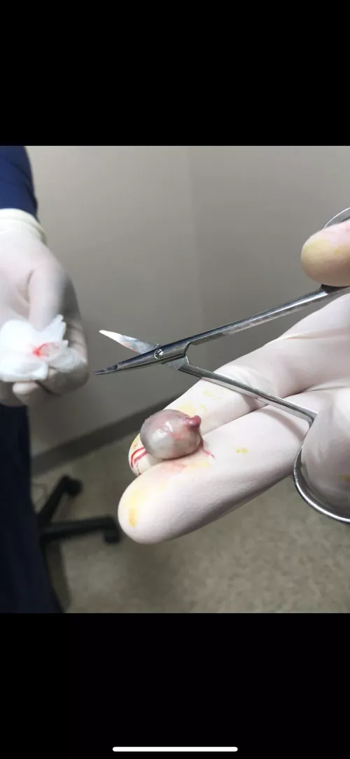 Cyst that was removed from my shoulder after 4 years