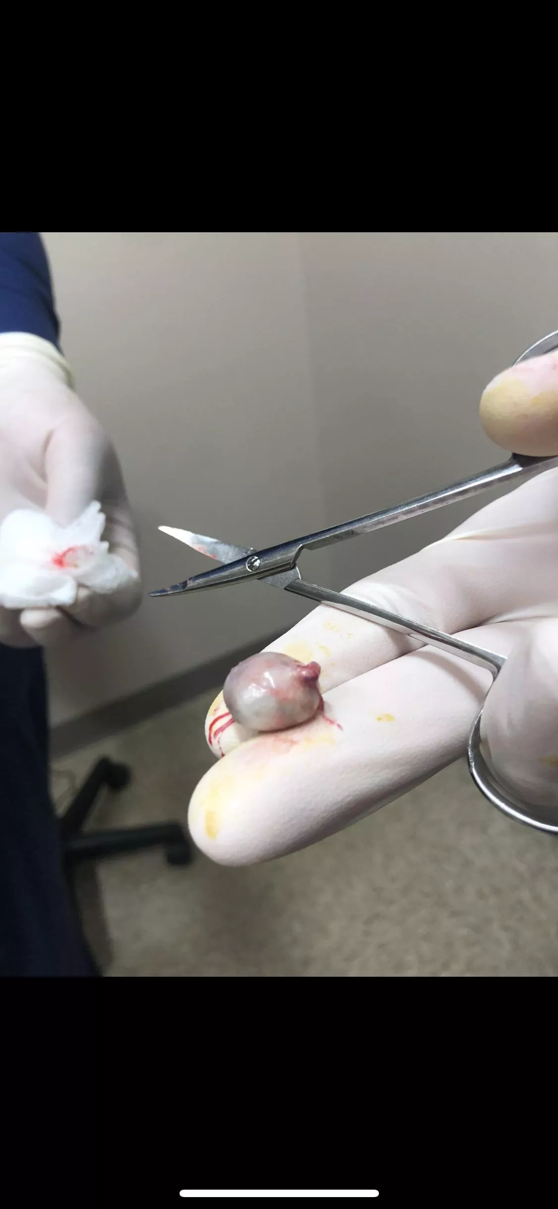 Cyst that was removed from my shoulder after 4 years