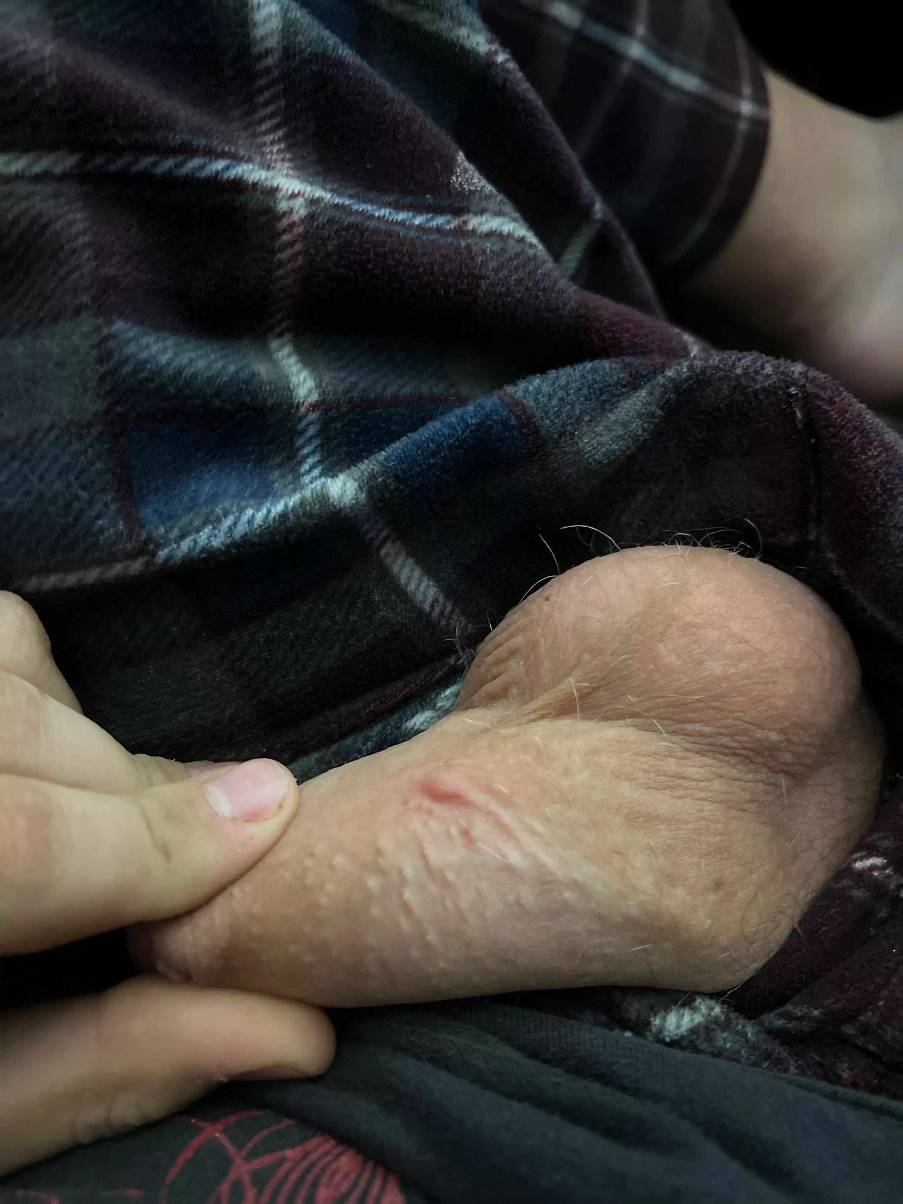 NSFW - Penis/Balls - What is this near the base of my shaft?