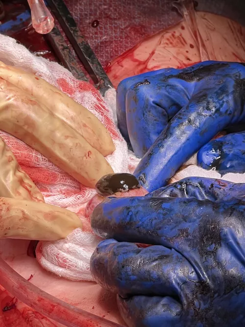 The removal of a chocolate cyst from my ovary