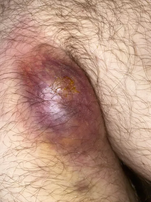 Access I had recently. I couldn’t even walk. Thought I could handle it myself at home, then I smelled it and saw how much was coming out and went to the doc.