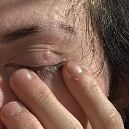 forbidden pop in my eyelid. it doesn’t feel like anything and i’ve had it a few months