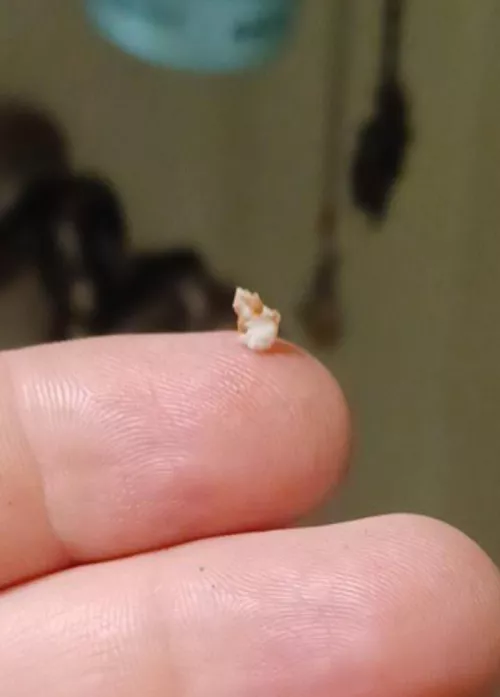 I've had a milia on my eyelid for years and I finally got it out