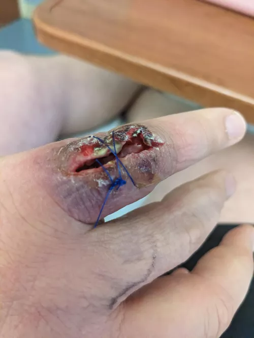 TW: open wound. Final update in chain