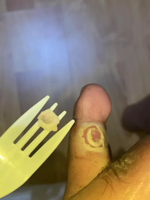 Wart fell off after 5 days. So happy.