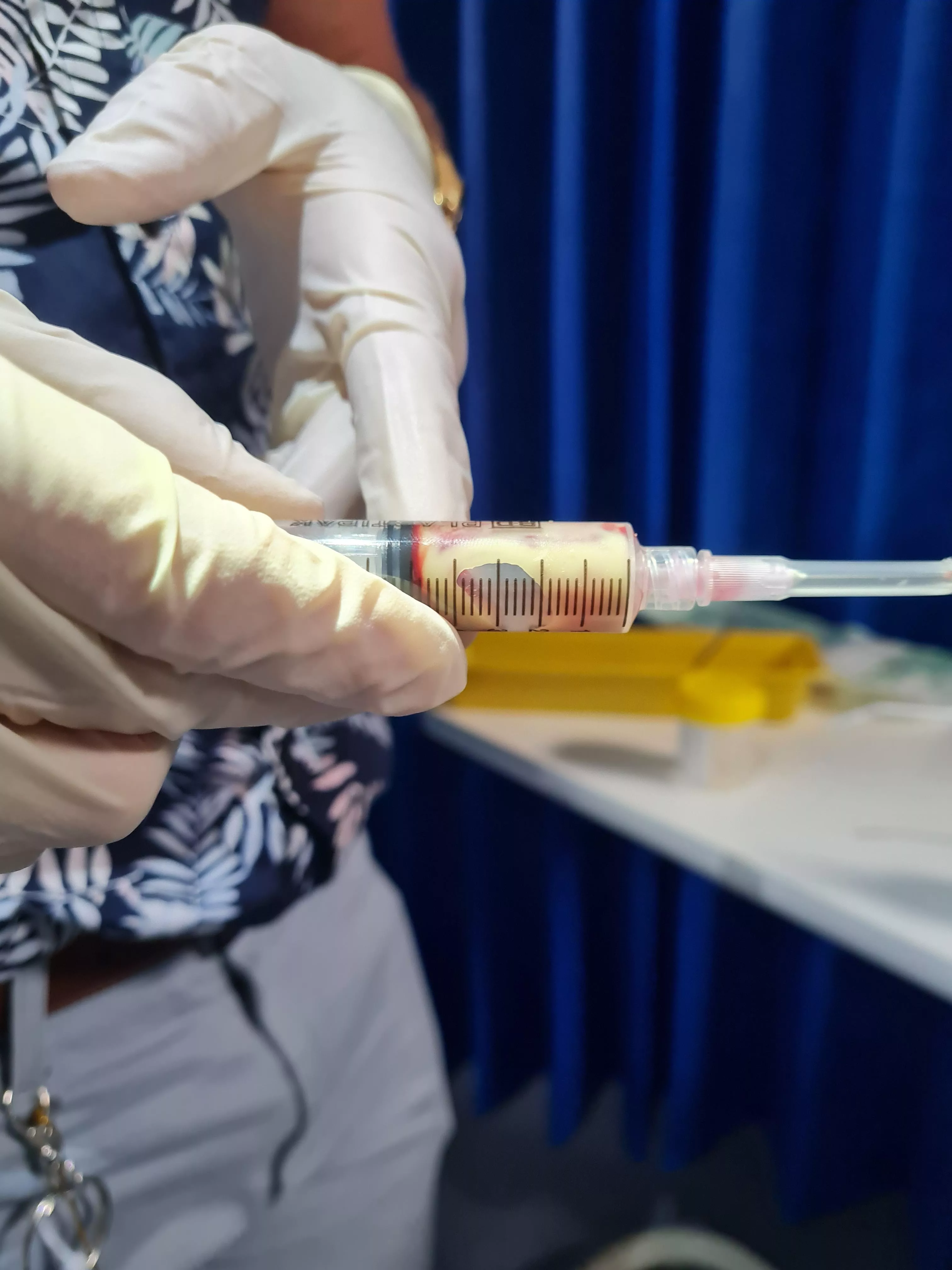 What they drained out of my tonsil abscess this morning!