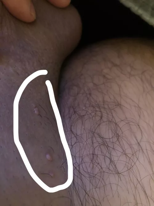 Any of idea of what this is . Near my private are