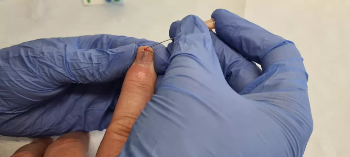 Doctor could not pop out this rose thorn