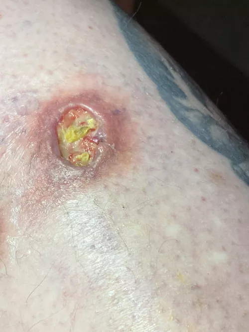 Pop turned into sepsis