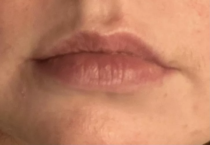 advice for lip fillers pls ? 💕