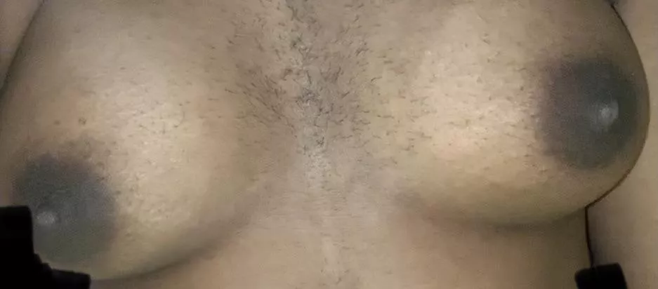 (F20, 5’0, 50kg) I’m a woman with hirsutism , which means I grow hair in places and patterns where men usually grow hair. I feel so disgusting. I feel like a man. No one will ever love me. I’ve been called a man all my life. (F20, 5’0, 50kg) I’m a woman with hirsutism , which means I grow hair in places and patterns where men usually grow hair. I feel so disgusting. I feel like a man. No one will ever love me. I’ve been called a man all my life.