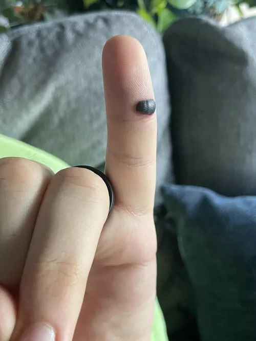 I can’t stop staring at my husband’s blood blister 😅