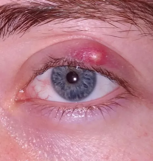 My Christmas miracle. My eye bout to give birth to the antichrist on Christmas