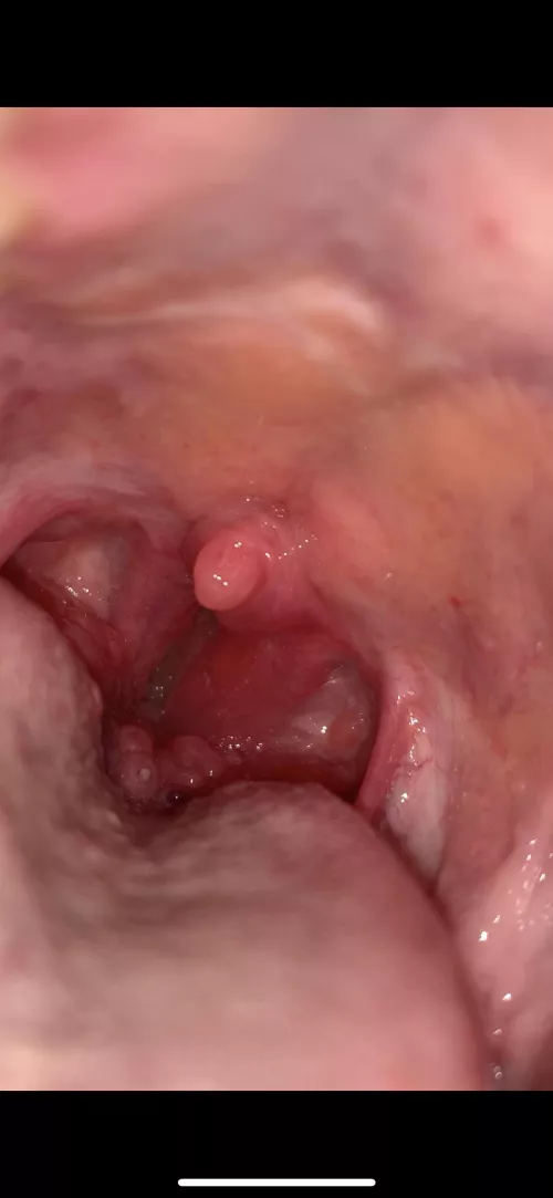 Nodules in the back of my throat forbidden pop?