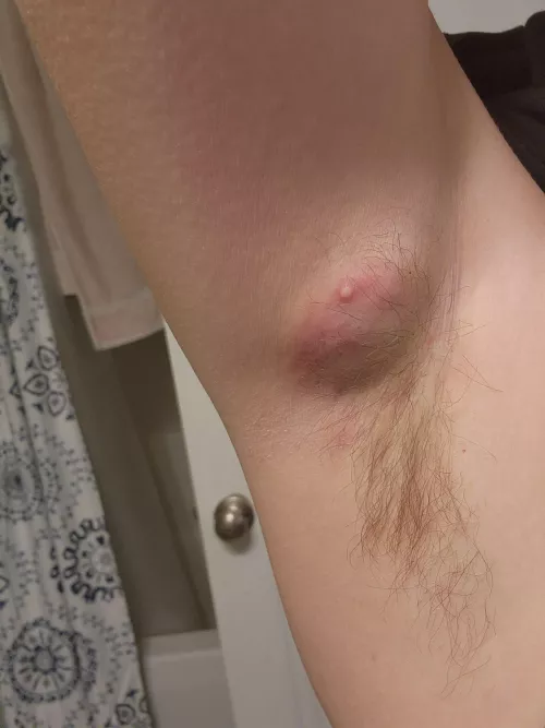 HS cyst ongoing for 5 weeks now.