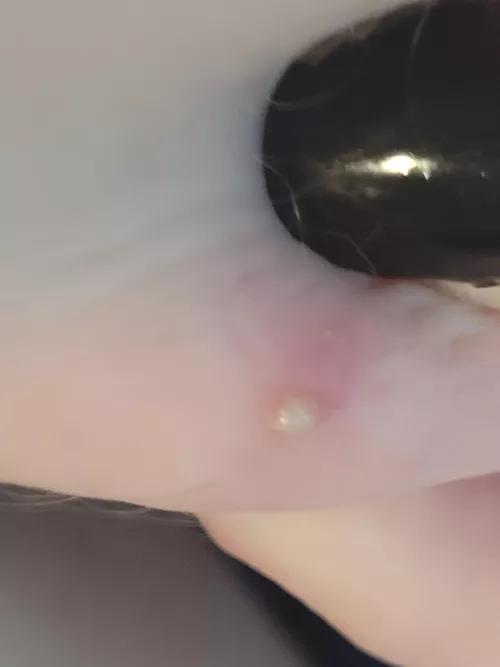 this little dude has been on the leg for 3 days finally was ready to pop