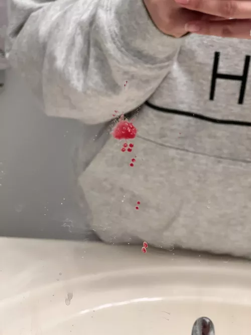 Aftermath of what I thought was gonna be a tiny whitehead 😳 nsfw because blood (oc)
