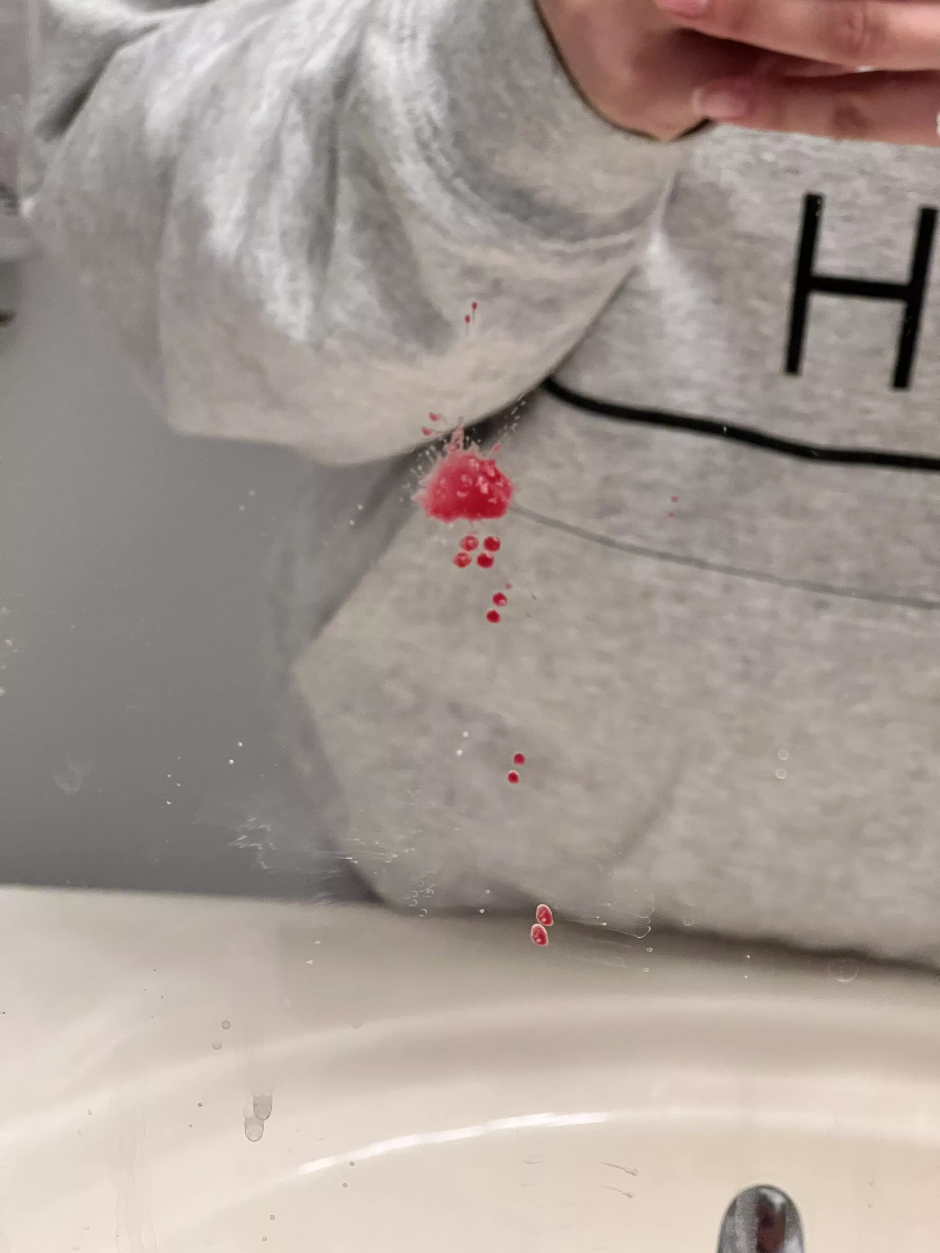 Aftermath of what I thought was gonna be a tiny whitehead 😳 nsfw because blood (oc)