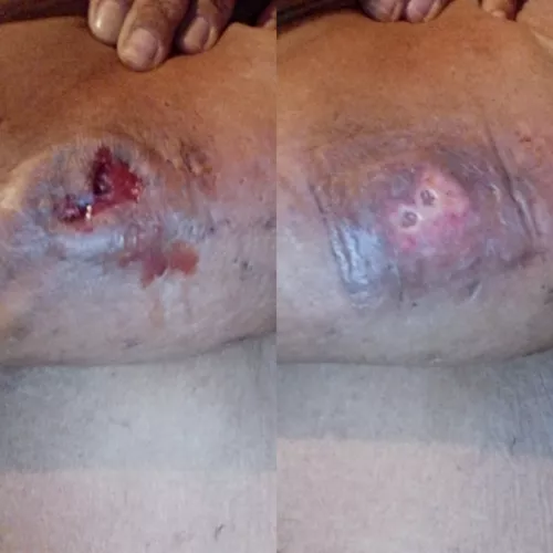 HS lesion left breast