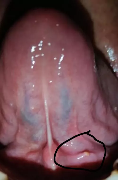 i have been having this tiny thing for the past 2 days,, it doest hurt but just i can feel it with my toung .. please help what would be this its yellowish in color