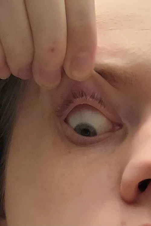 Just noticed the small pimple in my eyelid. Any tips for getting rid of it?