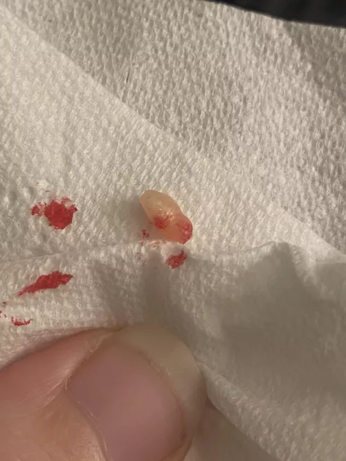 Lil…something popped out of husband’s leg