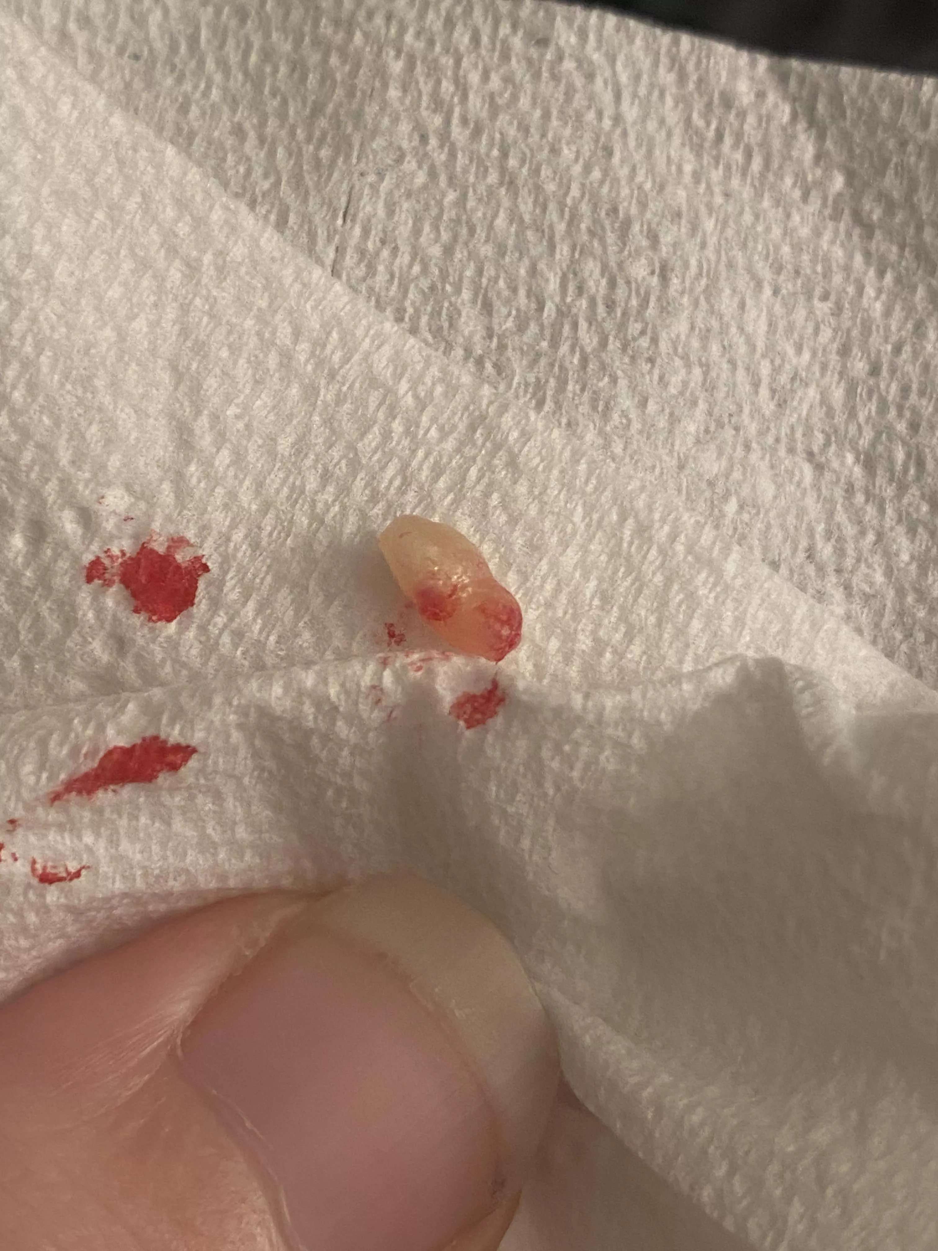 Lil…something popped out of husband’s leg