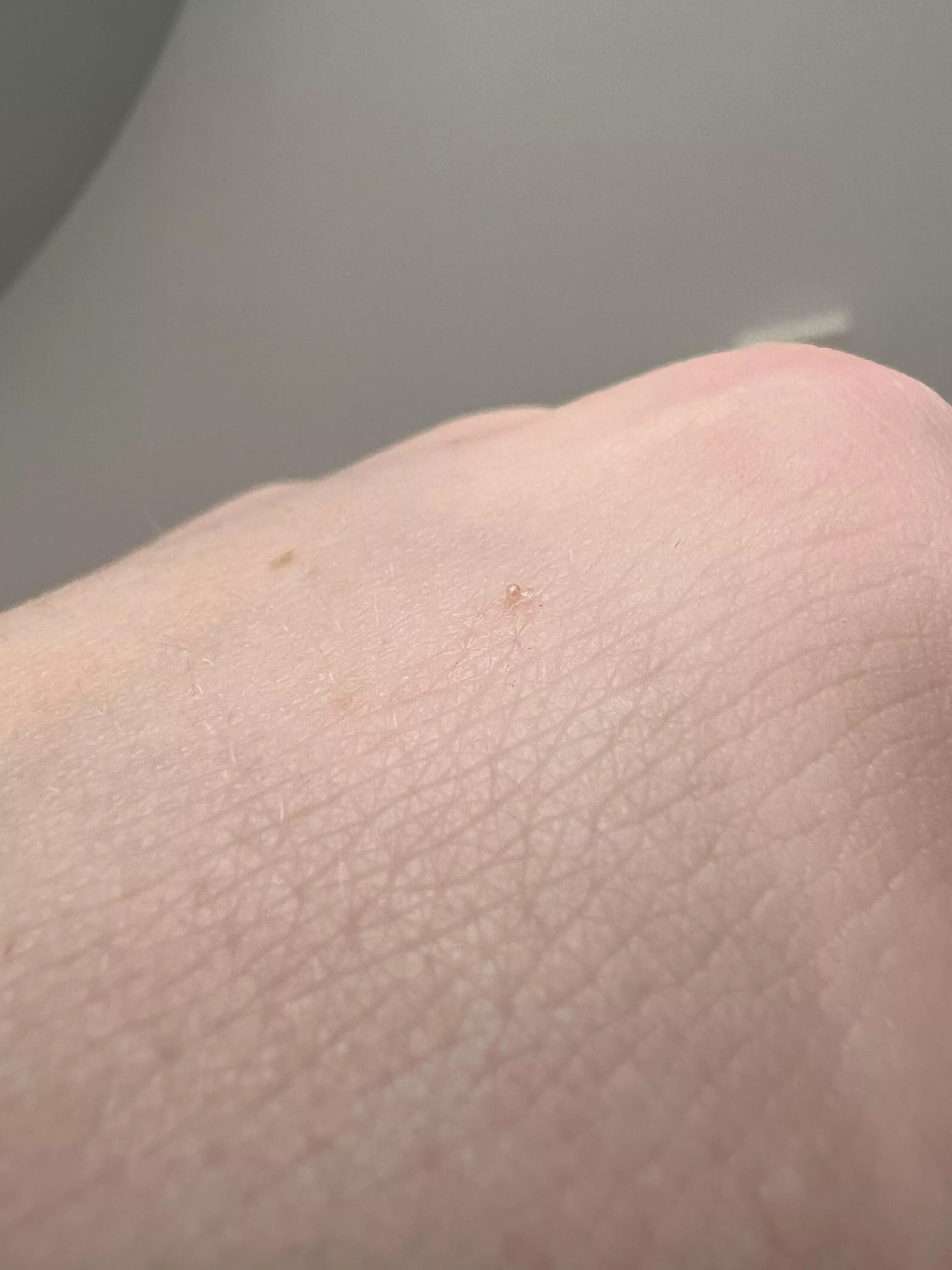 Milia I got out of forehead. Pretty little pearl 😁