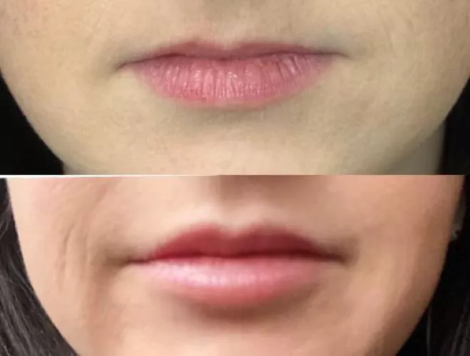 My first lip upgrade. What do y’all think?