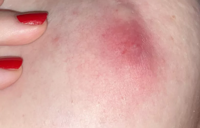 Yikes… been here for a good week now. Think I need to see a dr.