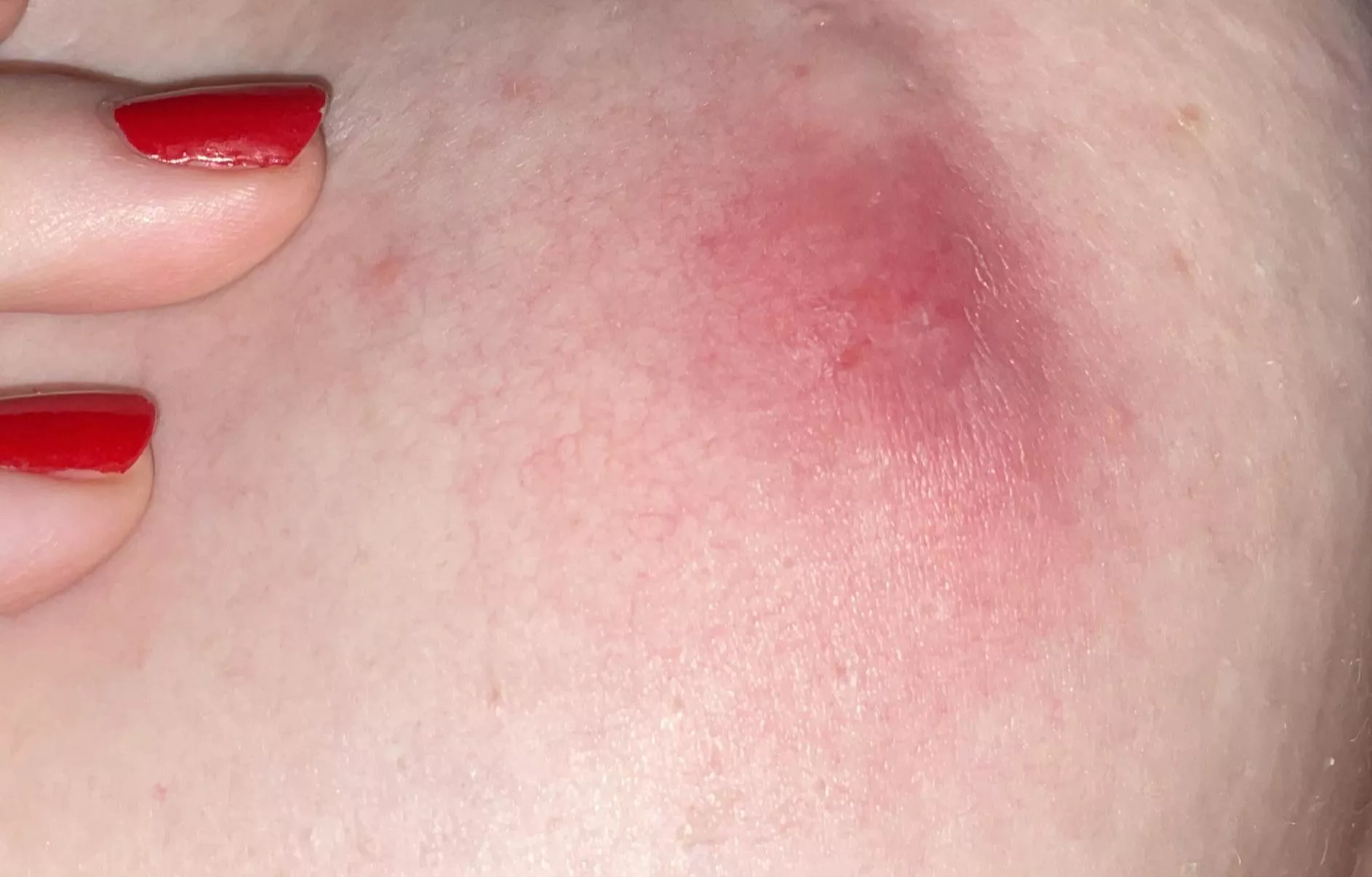 Yikes… been here for a good week now. Think I need to see a dr.