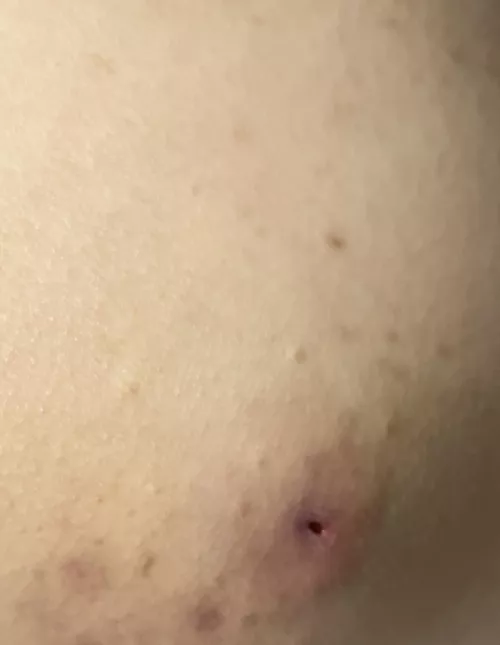 After popping this is what left of it and I wanna ask is this bad or will be healed?