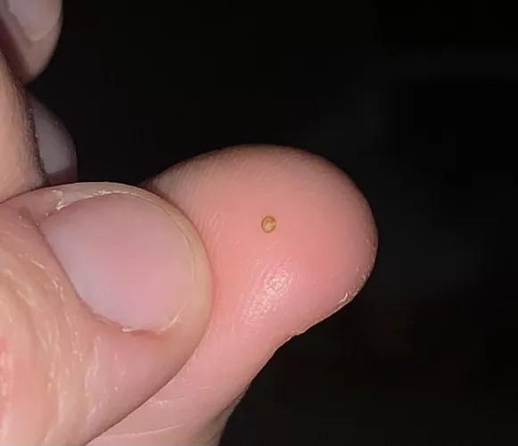 Have had a weird angry bump inside my ear canal for the past few days and I Scraped this absolute hard EGG out of it, enjoy