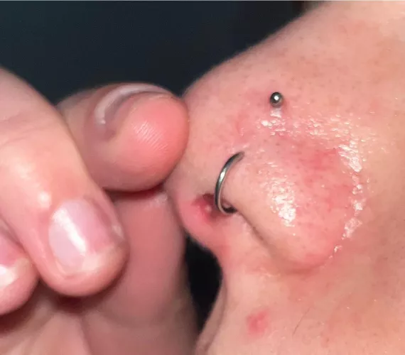 forbidden pop in nose…..shit hurts so bad 😭