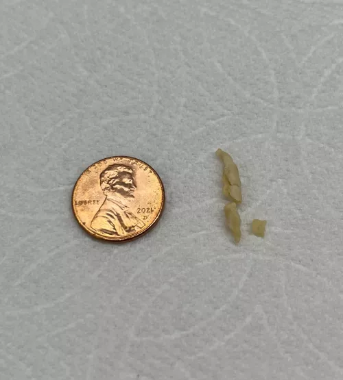 Rhinolith that I blew from my nose in two separate fragments