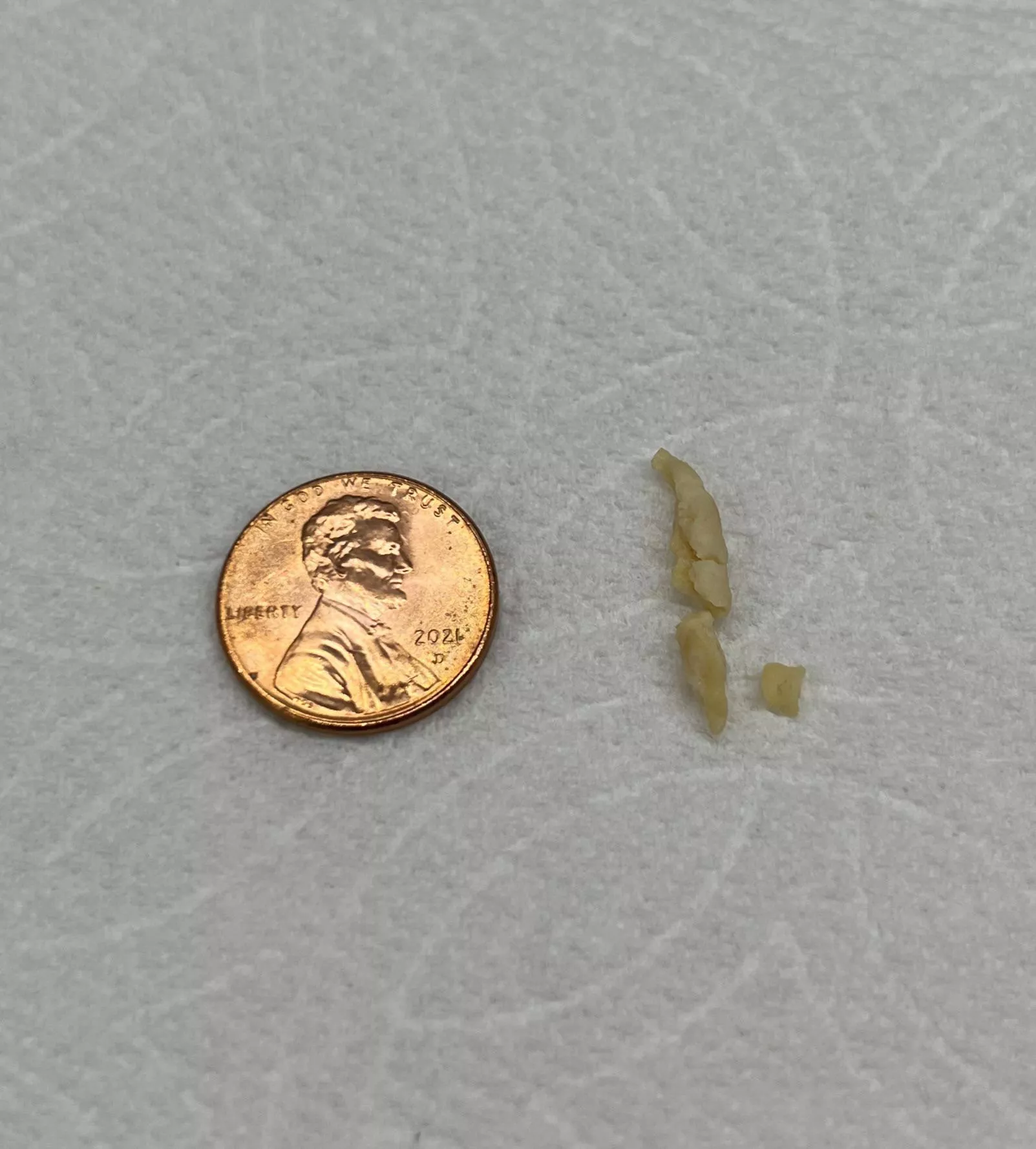 Rhinolith that I blew from my nose in two separate fragments